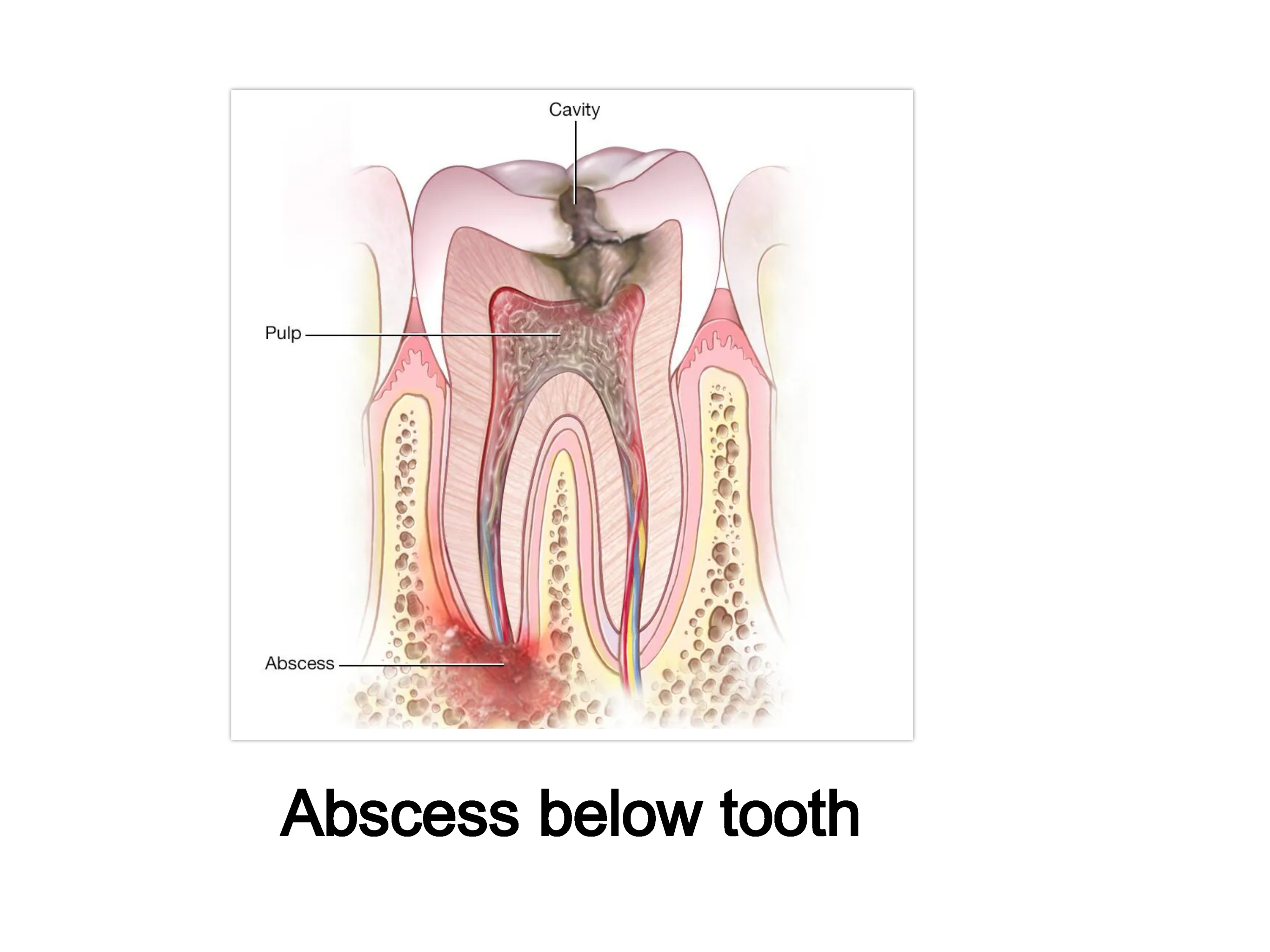 Dental Abscess below tooth