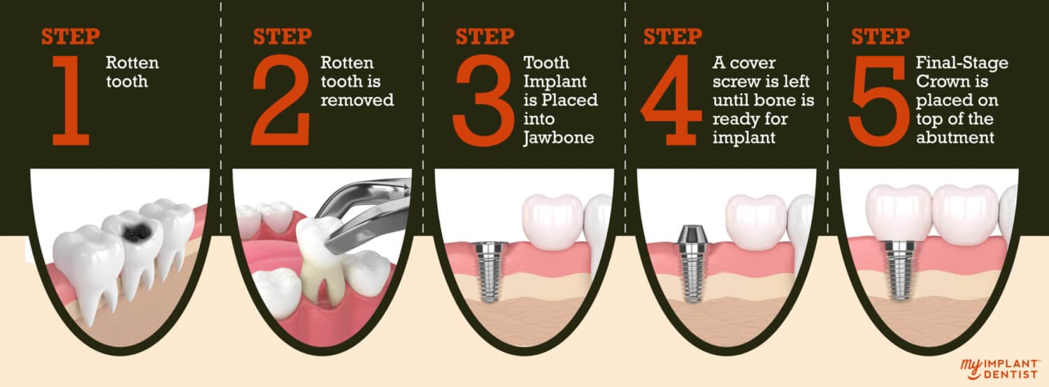 Dental Implant Basics