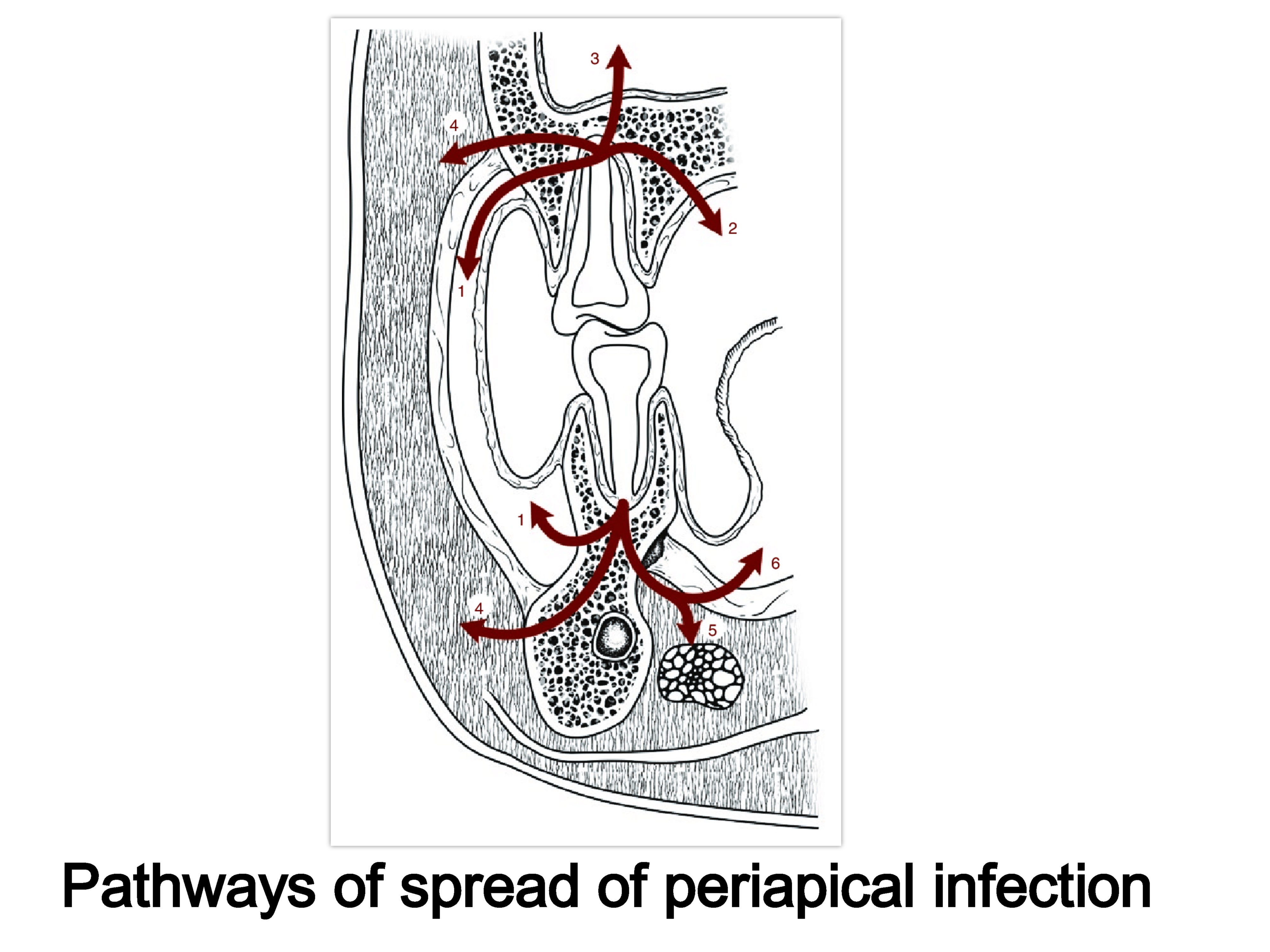 Pathways of spread of Dental periapical infection