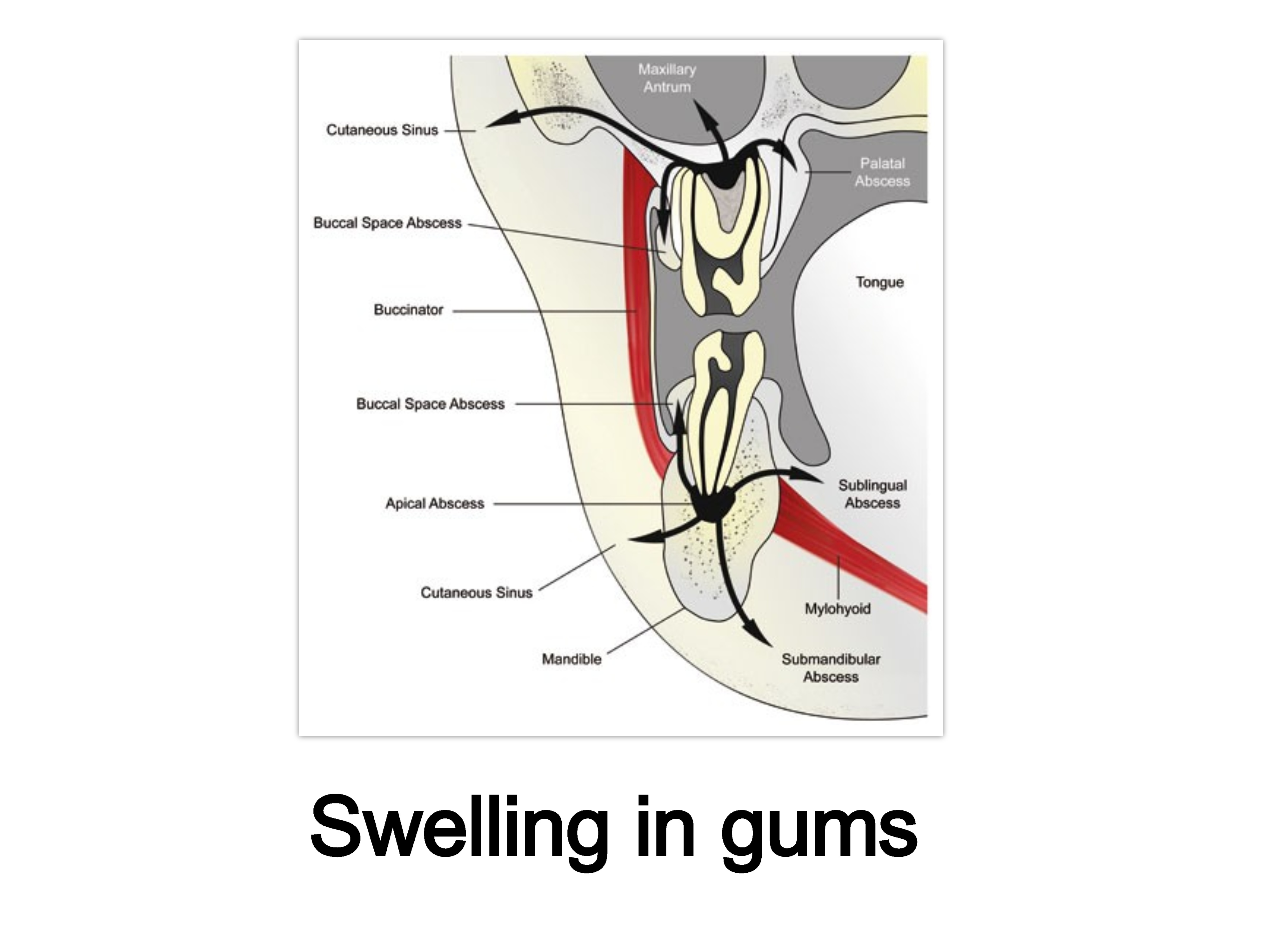 Dental Swelling in gums