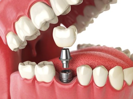 Dental Implant, Tooth Implant, Titanium Dental Implant