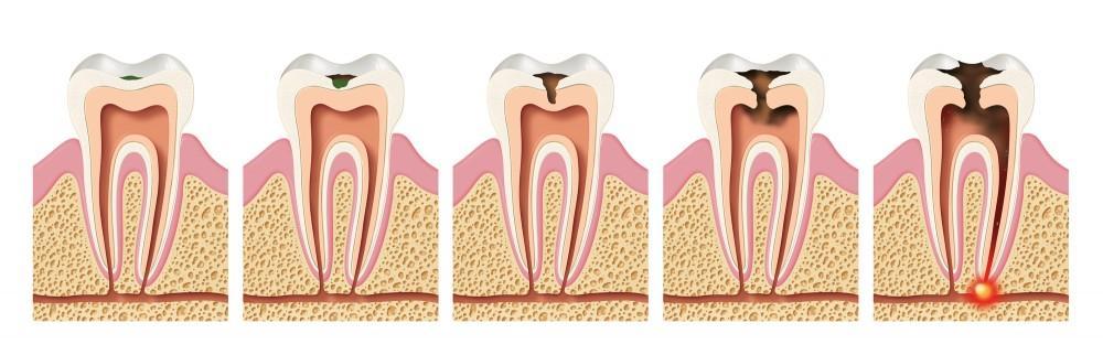 Stage of dental cavity