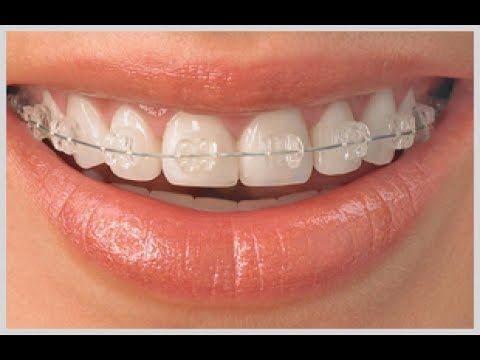 What are steps of Dental Scaling, Teeth Cleaning, Stains on teeth