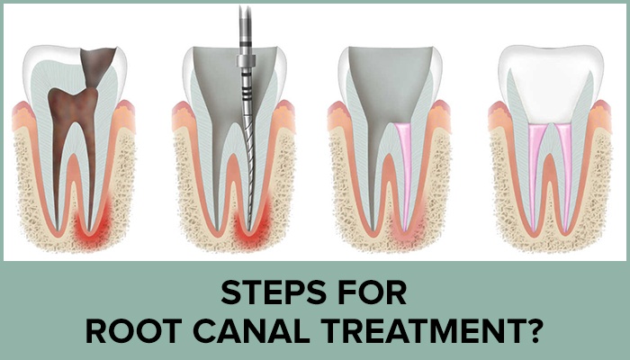 What are steps of Root Canal Treatment ?