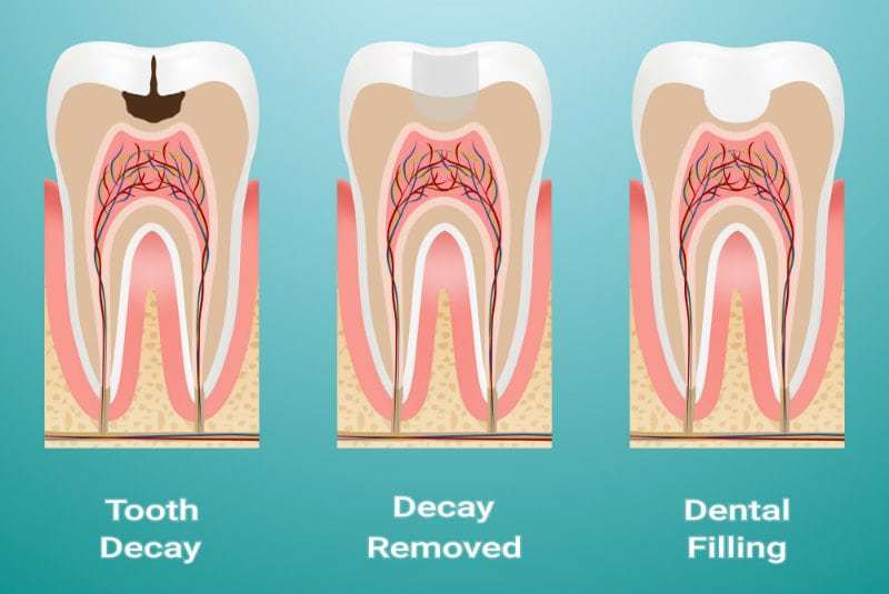 Composite Restoration Basics